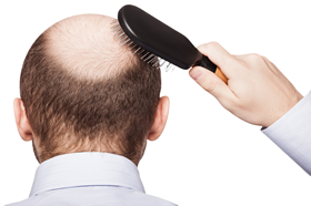 trapianto di capelli